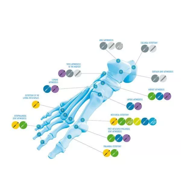 Distributeur de dispositifs médicaux en orthopédie et en traumatologie, Saint-Paul, ERGONE medical services
